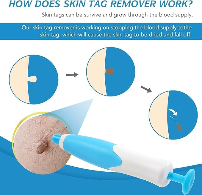Auto Skin Tag Remover Kit for Face & Body Upgraded Fast and Easy Removal Pen with 40 Removal Bands & 10 Cleansing Wipes