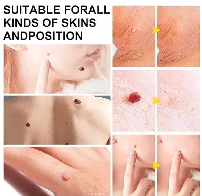 Auto Skin Tag Remover Kit for Face & Body Upgraded Fast and Easy Removal Pen with 40 Removal Bands & 10 Cleansing Wipes