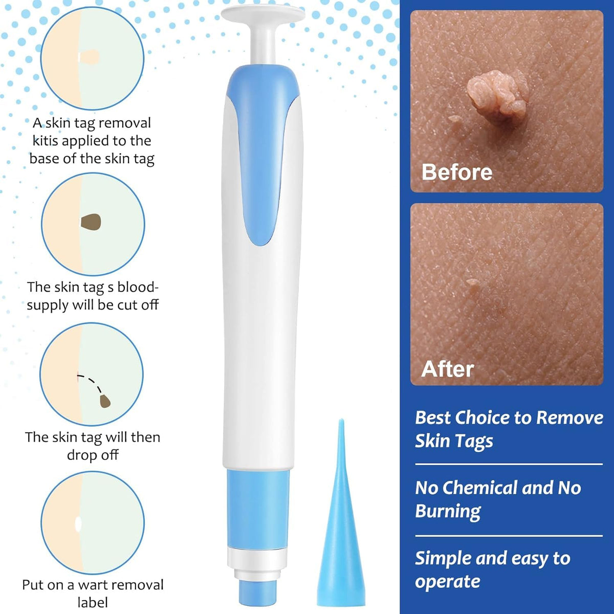 Auto Skin Tag Remover Kit for Face & Body Upgraded Fast and Easy Removal Pen with 40 Removal Bands & 10 Cleansing Wipes