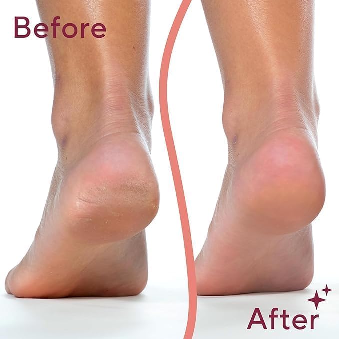 Hanglow Electric Callus Remover for Feet – Rechargeable Foot Dead Skin Remover with 2 Roller Heads PACK OF 1