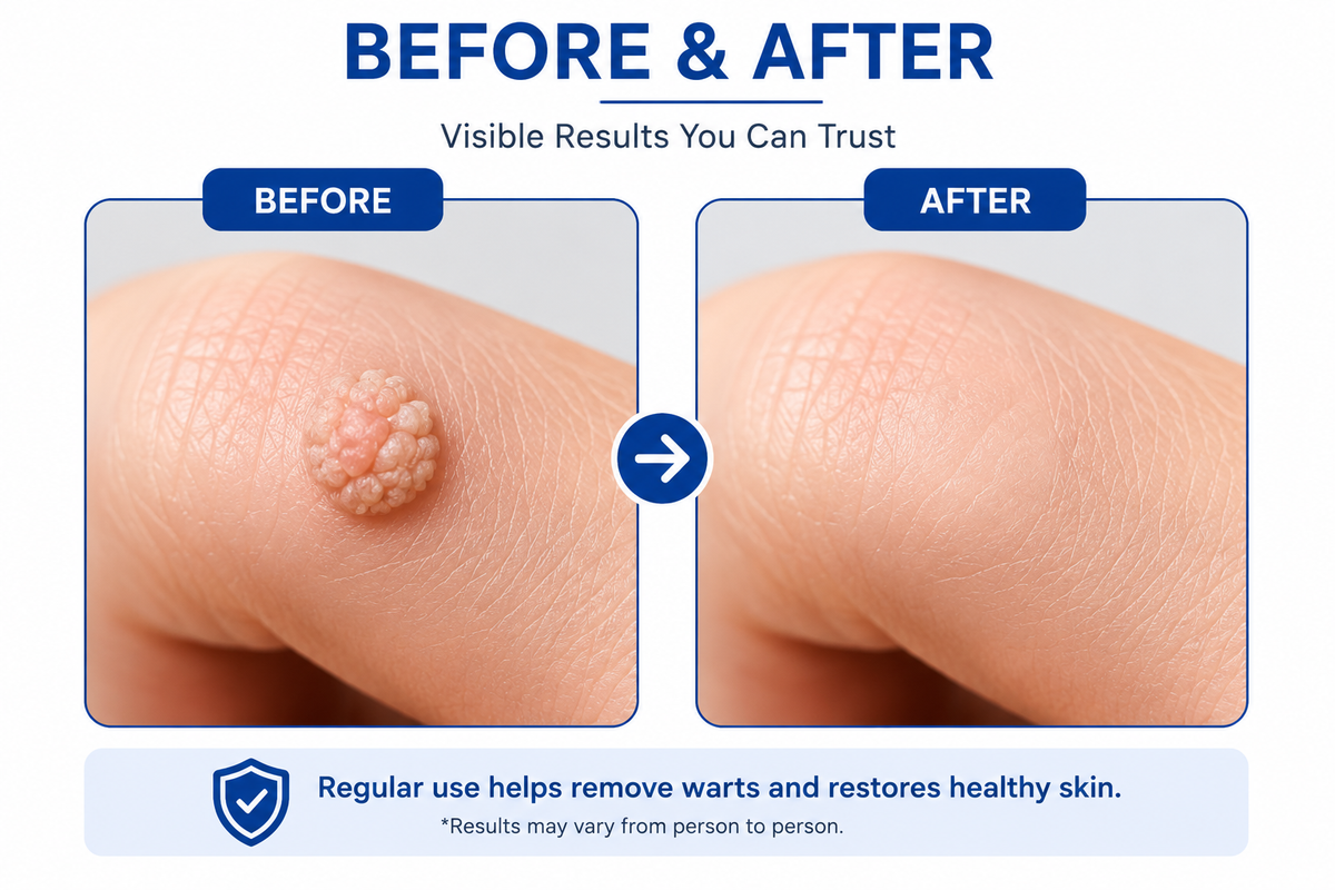 Gentle Warts Remover Cream Pack Of 1