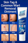 Wart Remover Ointment PACK OF 1