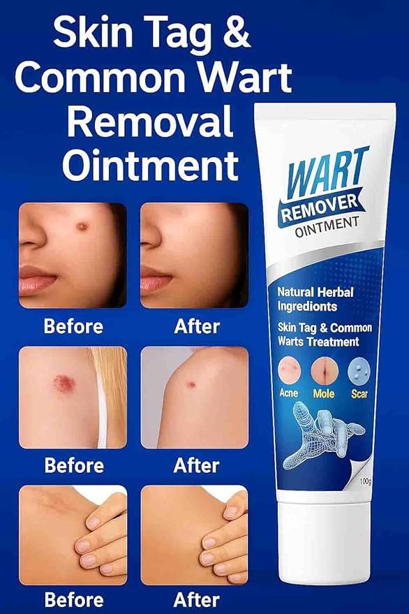 Wart Remover Ointment PACK OF 2