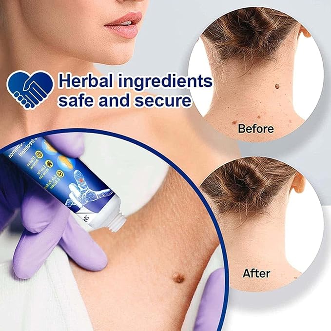 Wart Remover Ointment PACK OF 2