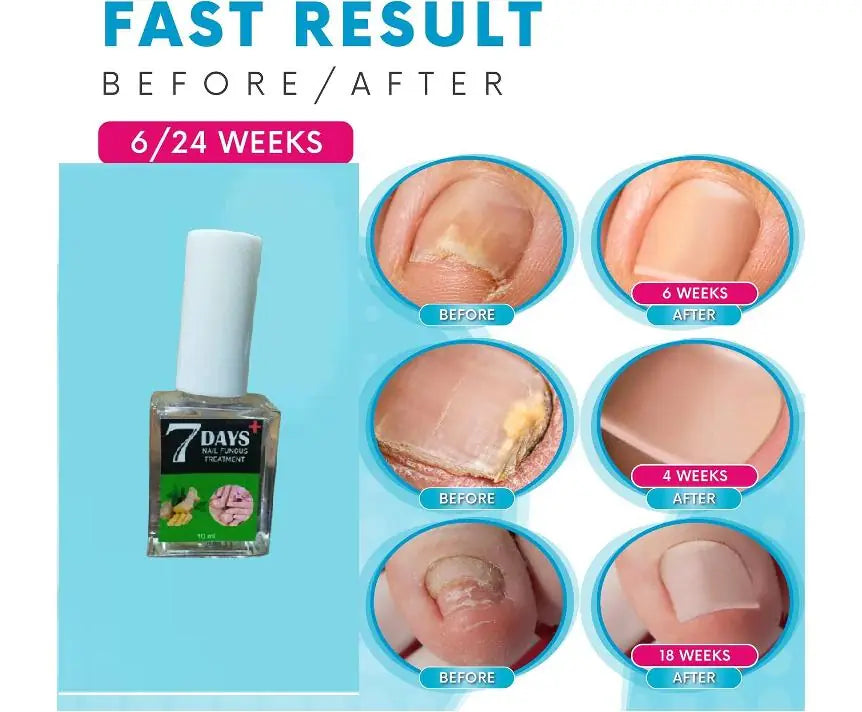 Nial Treatment Polish