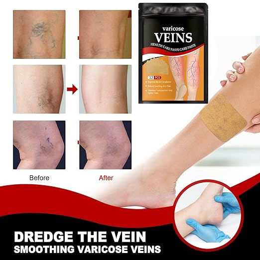 Varicose Veins Sticker for Legs, Against Spider Veins Patch(PACK 2)