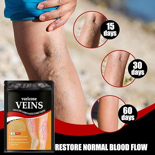Varicose Veins Sticker for Legs, Against Spider Veins Patch(PACK 2)